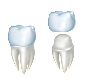 dental crowns and bridges