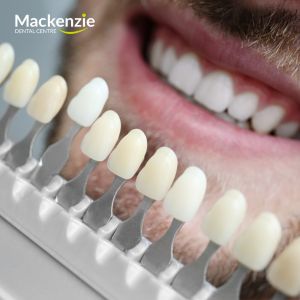 What you need to know before choosing porcelain veneers