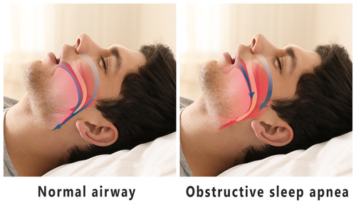 sleep apnea man airways sleeping woodbridge