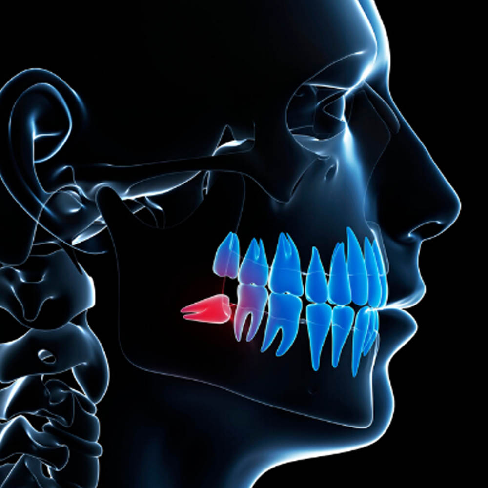 3D scan of impacted wisdom tooth